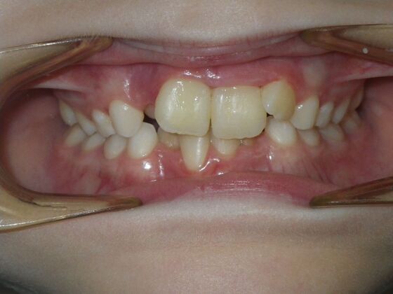 Orthodontic treatment in Phases: Case 11 - Before
