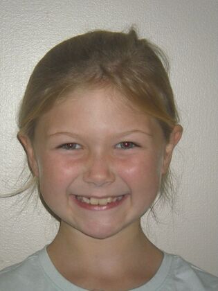 Orthodontic treatment in Phases: Case 11 - Before