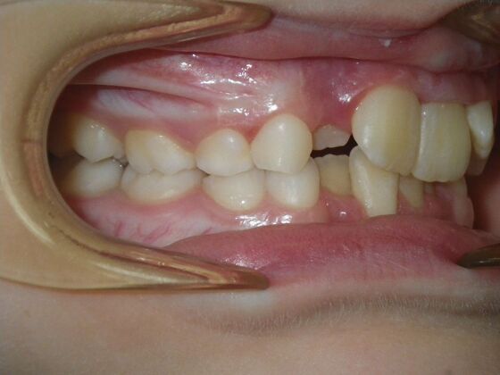 Orthodontic treatment in Phases: Case 11 - Before