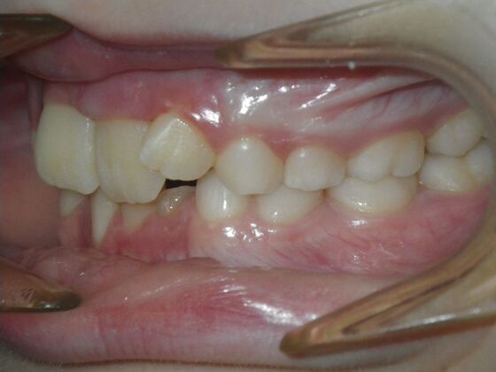 Orthodontic treatment in Phases: Case 11 - Before