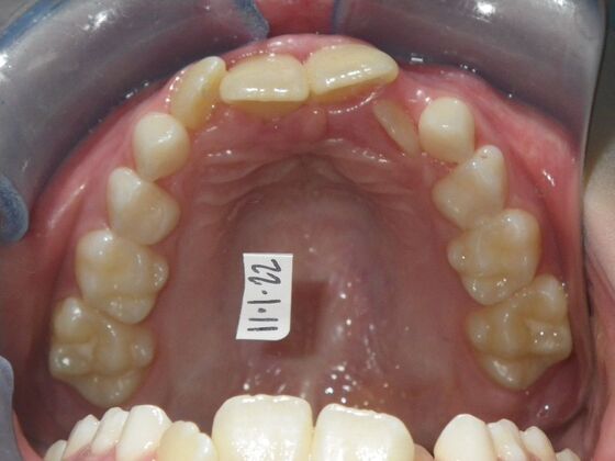 Orthodontic treatment in Phases: Case 11 - Before