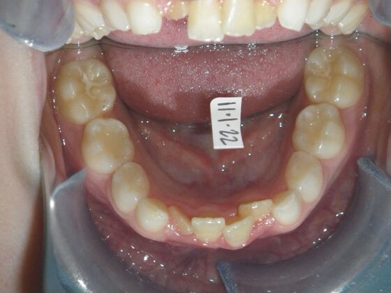 Orthodontic treatment in Phases: Case 11 - Before