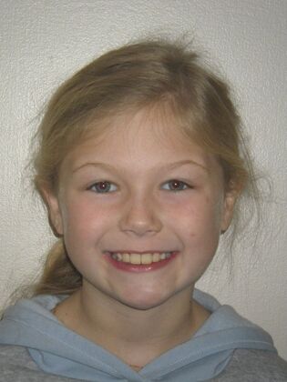 Orthodontic treatment in Phases: Case 11 - After