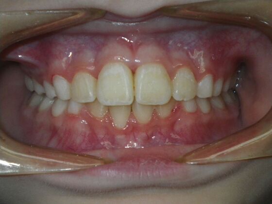 Orthodontic treatment in Phases: Case 11 - After