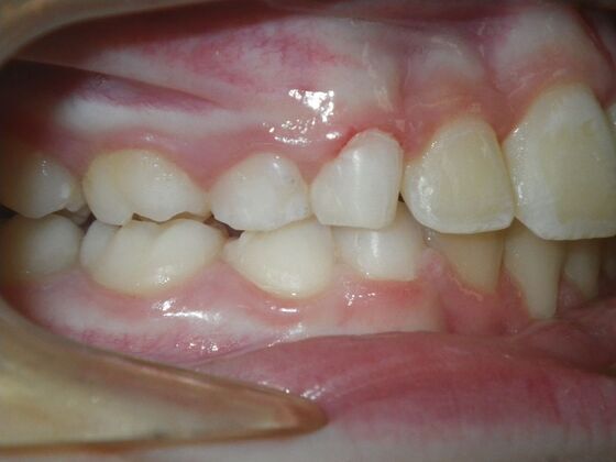Orthodontic treatment in Phases: Case 11 - After