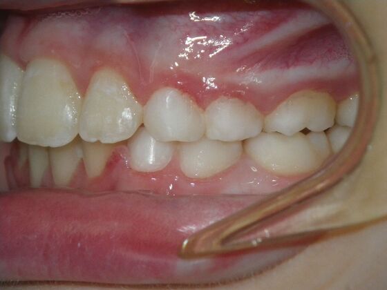 Orthodontic treatment in Phases: Case 11 - After