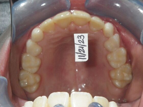 Orthodontic treatment in Phases: Case 11 - After
