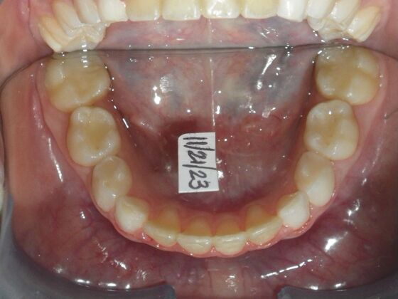 Orthodontic treatment in Phases: Case 11 - After