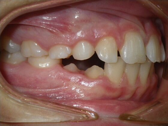 Orthodontics: Case 44 - Before
