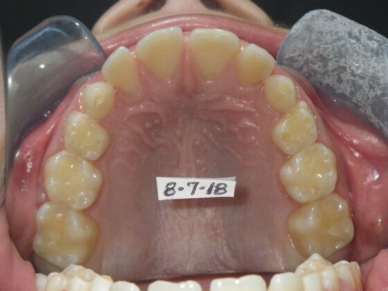 Orthodontics: Case 44 - Before