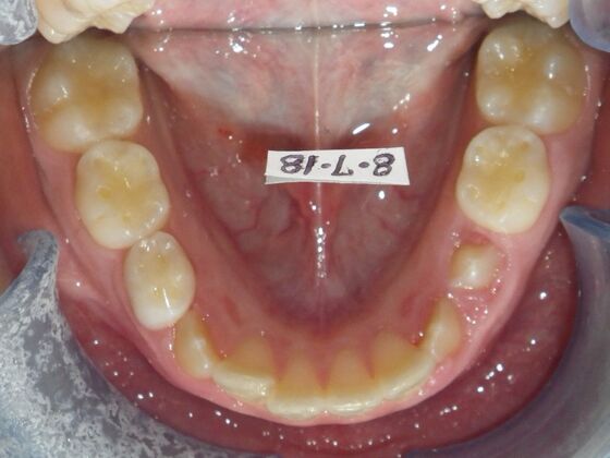 Orthodontics: Case 44 - Before