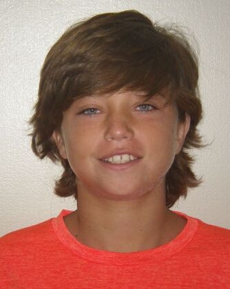 Orthodontics: Case 44 - Before