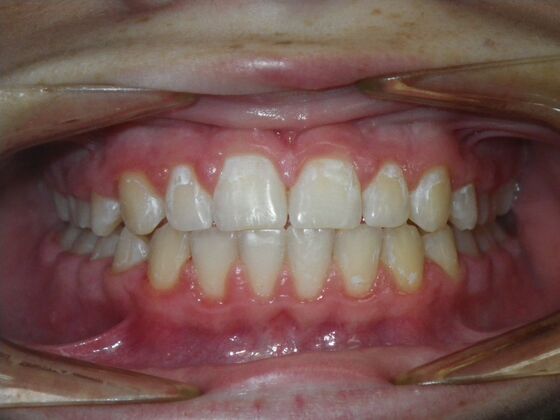 Orthodontics Case 44 - After