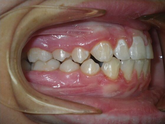 Orthodontics: Case 44 - After