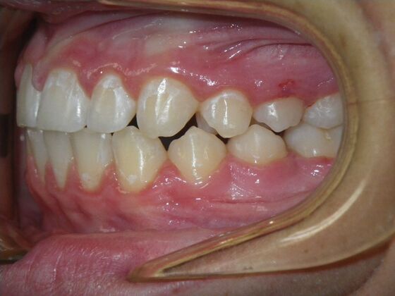 Orthodontics: Case 44 - After