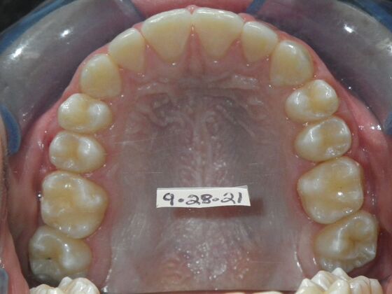 Orthodontics: Case 44 - After