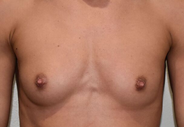 Breast Augmentation Case 747 - Before