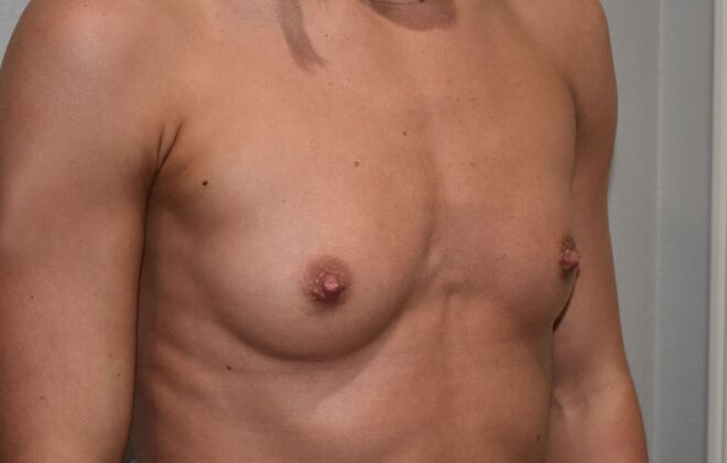 Breast Augmentation: Case 747 - Before
