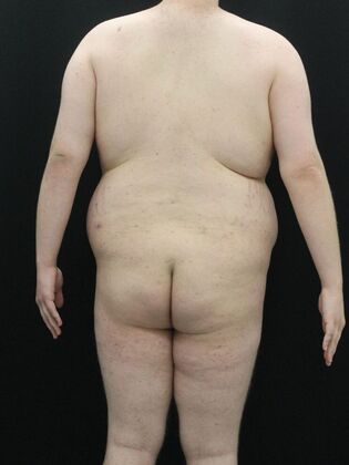 Liposuction Case 10 - Before