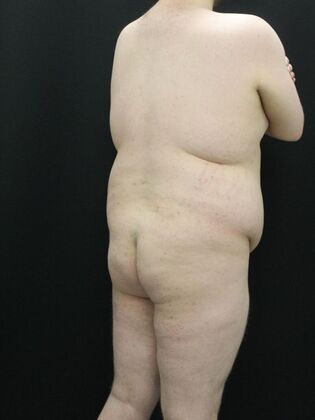 Liposuction: Case 10 - Before