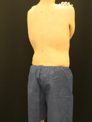 Liposuction: Case 10 - After