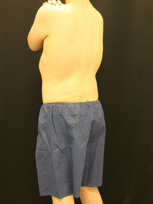 Liposuction: Case 10 - After