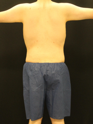 Liposuction Case 10 - After