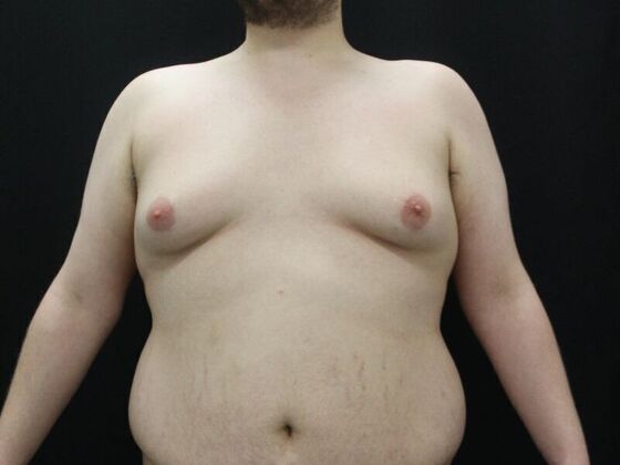 Gynecomastia & Male Breast Reduction Case 2 - Before