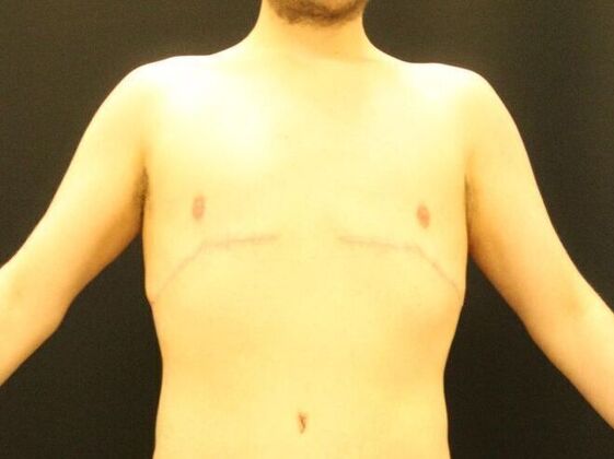 Gynecomastia & Male Breast Reduction Case 2 - After
