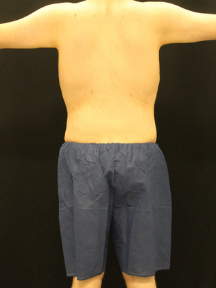 Tummy Tuck: Case 24 - After