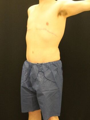 Tummy Tuck: Case 24 - After