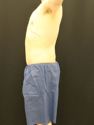 Tummy Tuck: Case 24 - After