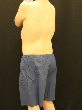 Tummy Tuck: Case 24 - After