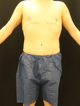 Tummy Tuck Case 24 - After