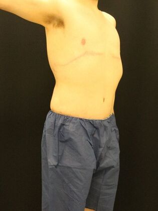 Tummy Tuck: Case 24 - After