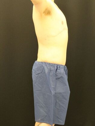 Tummy Tuck: Case 24 - After