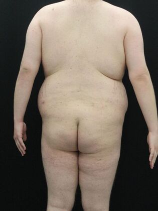 Tummy Tuck: Case 24 - Before