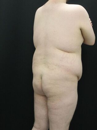 Tummy Tuck: Case 24 - Before