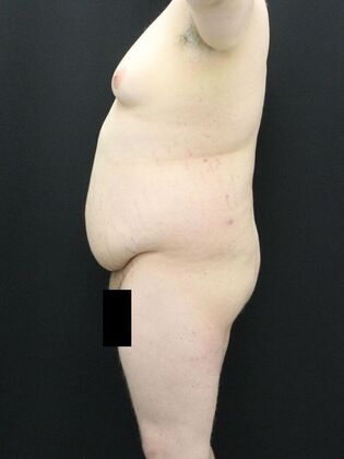 Tummy Tuck: Case 24 - Before