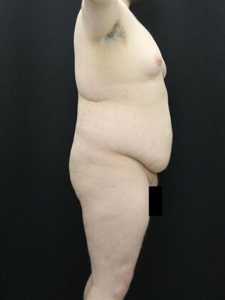 Tummy Tuck: Case 24 - Before