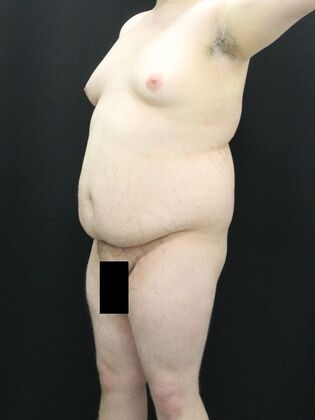 Tummy Tuck: Case 24 - Before