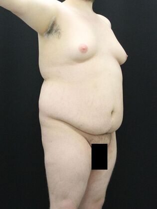 Tummy Tuck: Case 24 - Before