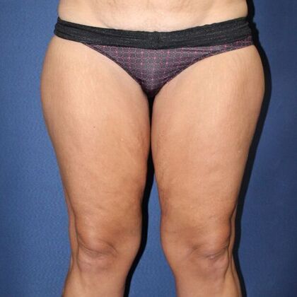 Thigh Lift & Reduction Case 4 - Before