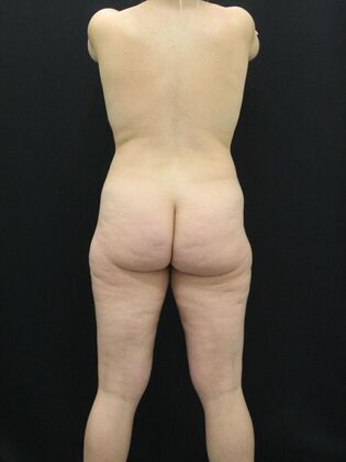 Thigh Lift & Reduction: Case 5 - Before
