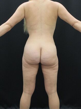 Thigh Lift & Reduction: Case 5 - After