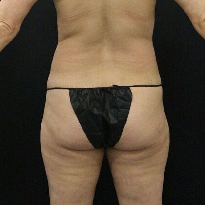 Thigh Lift & Reduction: Case 6 - Before