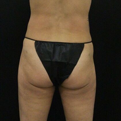 Thigh Lift & Reduction: Case 6 - After