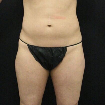 Thigh Lift & Reduction Case 6 - Before