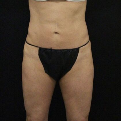 Thigh Lift & Reduction Case 6 - After