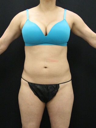 Liposuction Case 13 - Before